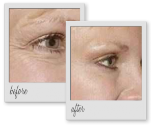 botox-wrinkles-before-after-aesthetics-med-spa-houston-img-01