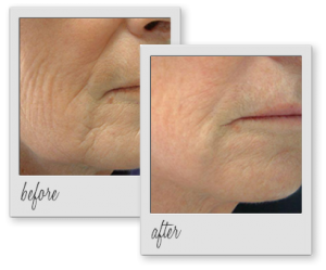 laser_skin_tightening_before_after_aesthetics_med_spa_houston_img_02